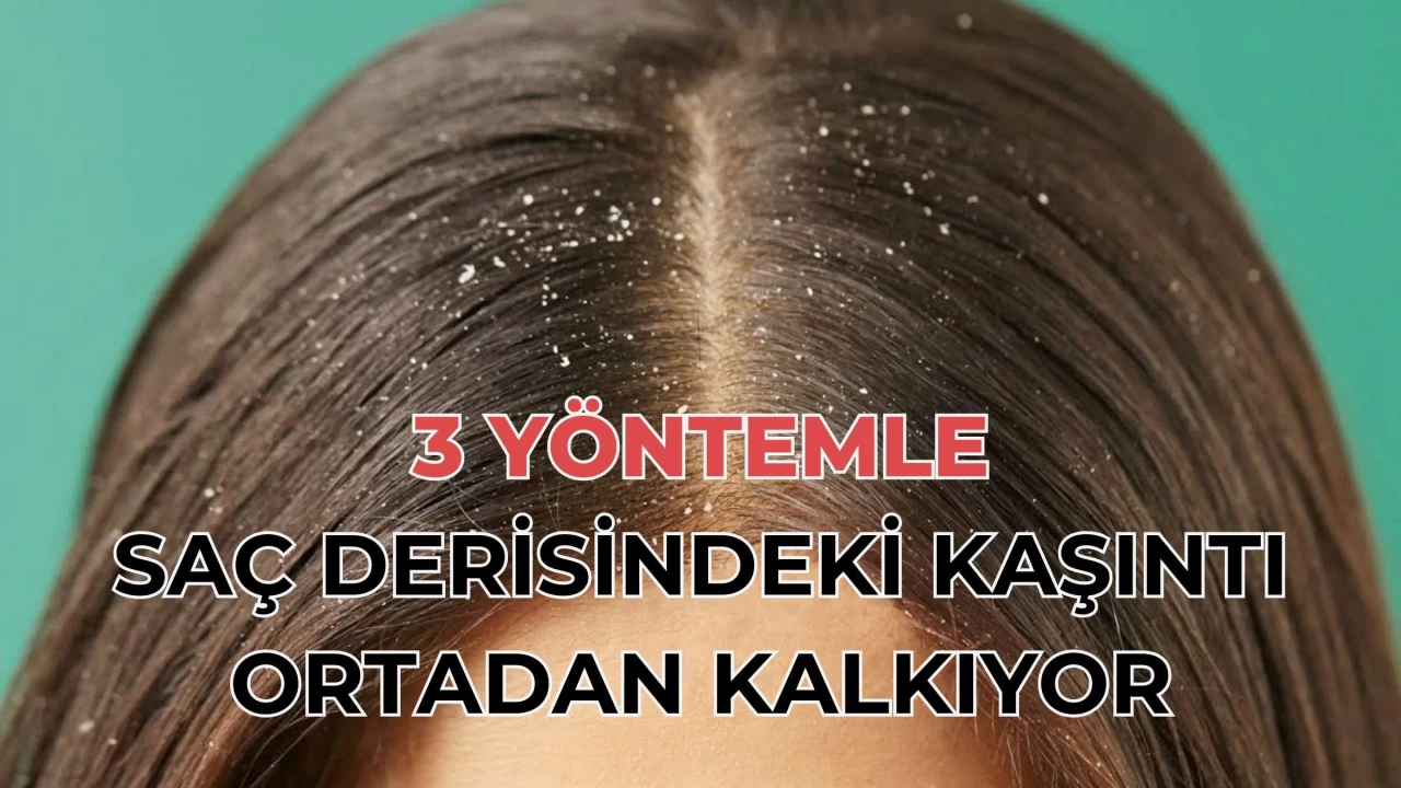 Saç Derinizi 3 Yöntemle Temizleyin: Saçtaki Kaşıntıyı Bitirecek Tavsiyeler