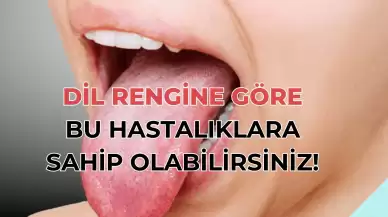 Dilinizin Rengine Bakarak Hastalığınızı Öğrenebilirsiniz! Dildeki Kırmızı, Sarı, Yeşil, Kahverengi Renkler Ne Anlama Geliyor?