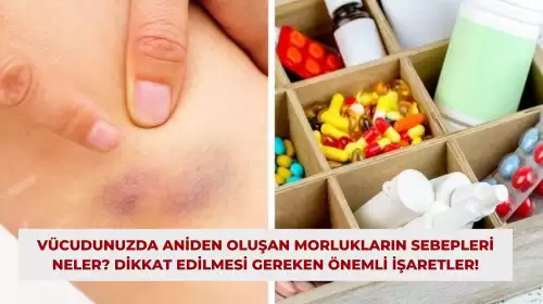 Vücudunuzda Aniden Oluşan Morlukların Sebepleri Neler? Dikkat Edilmesi Gereken Önemli İşaretler!